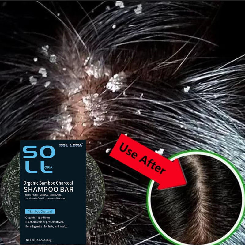 Hair Care Dandruff - Veloce Antiforfora Trattamento Dei Capelli Sapone